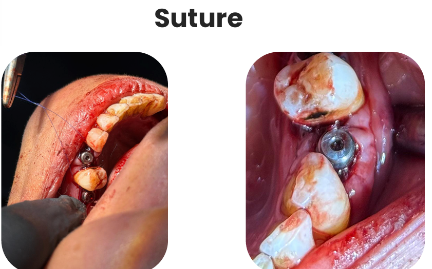 Suture